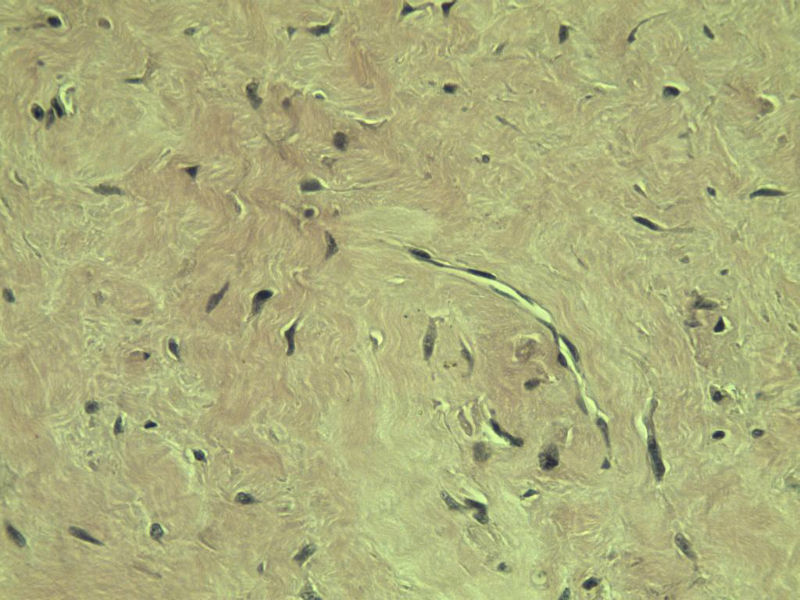 腘窝包块图12 腘窝包块图12