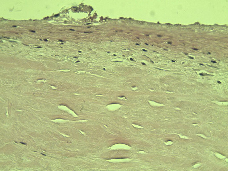 腘窝包块图13 腘窝包块图13