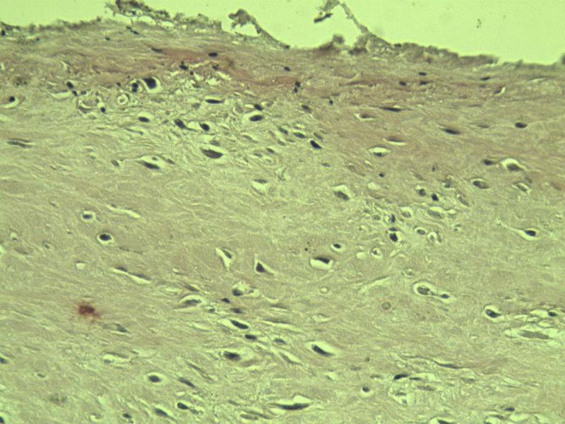 腘窝包块图14 腘窝包块图14