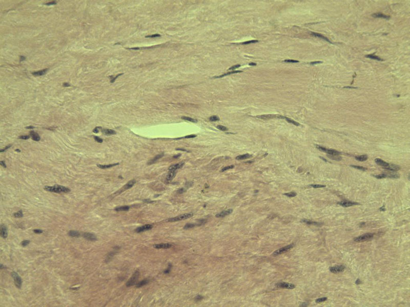 腘窝包块图15 腘窝包块图15