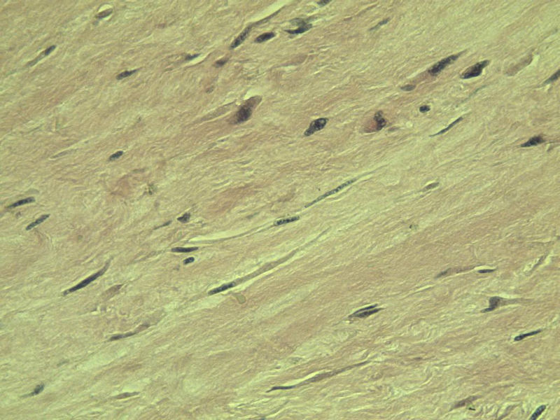 腘窝包块图16 腘窝包块图16
