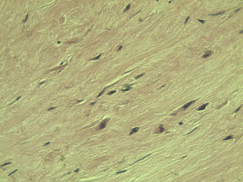 腘窝包块图17 腘窝包块图17