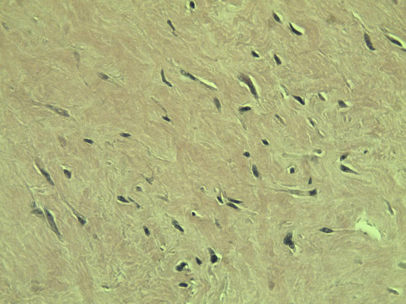 腘窝包块图18 腘窝包块图18