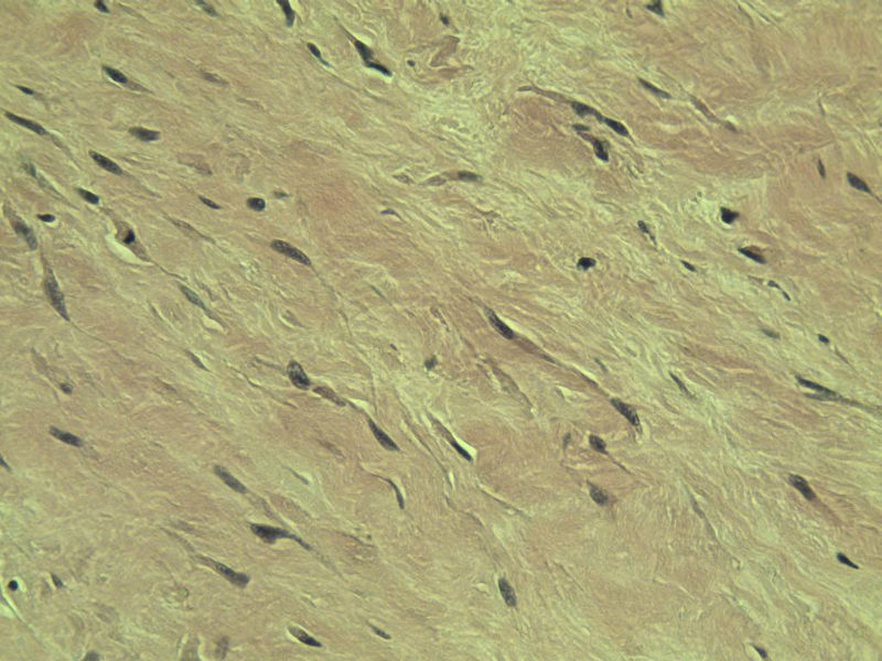 腘窝包块图19 腘窝包块图19