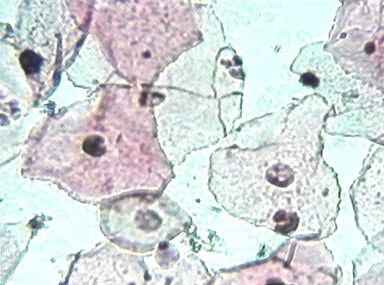 大家看看这是不是挖空细胞图5