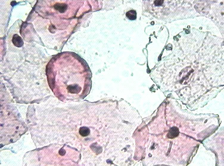 大家看看这是不是挖空细胞图6