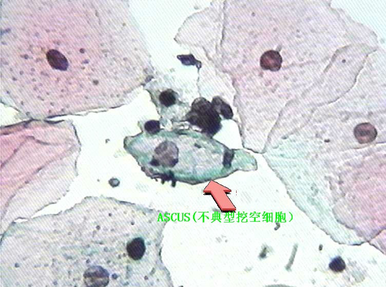 大家看看这个病人有什么细胞？图2