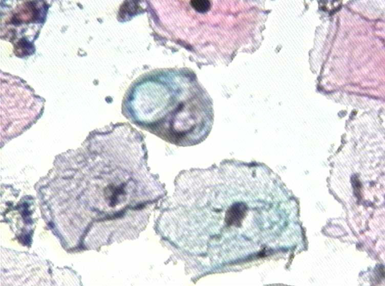 大家看看这个病人有什么细胞？图4