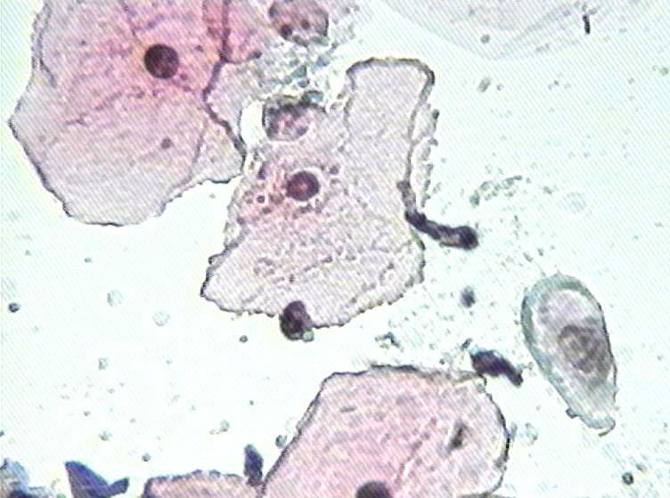 大家看看这个病人有什么细胞？图5