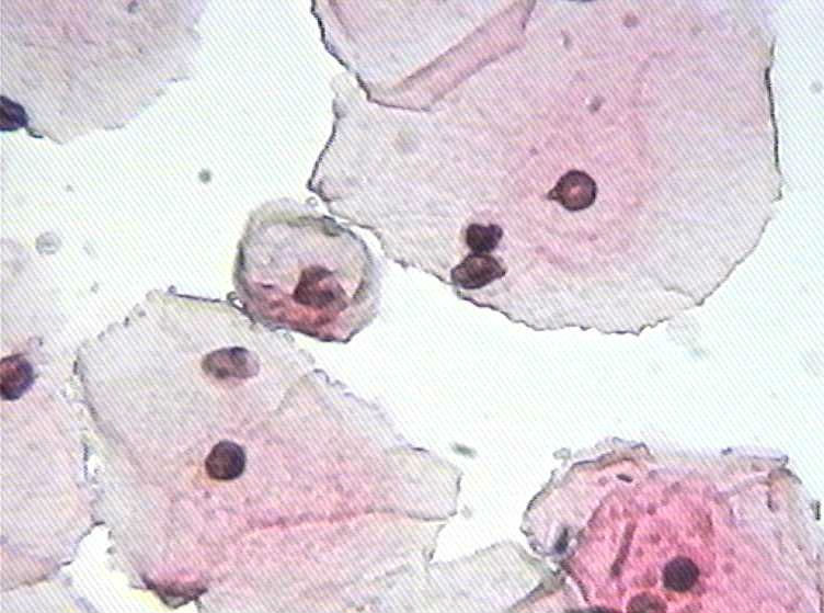 大家看看这个病人有什么细胞？图6