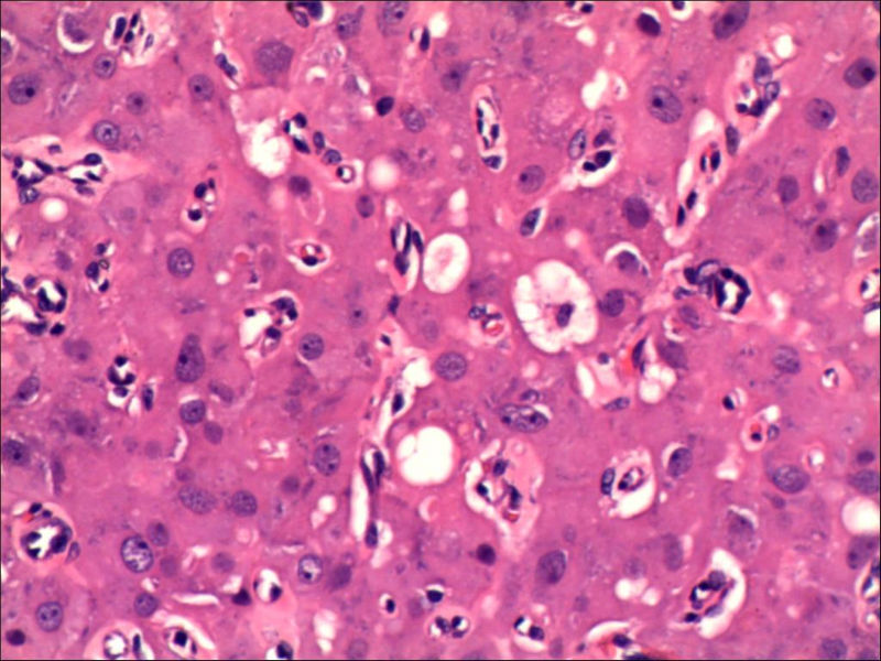 卵巢肿物图2 卵巢肿物图2