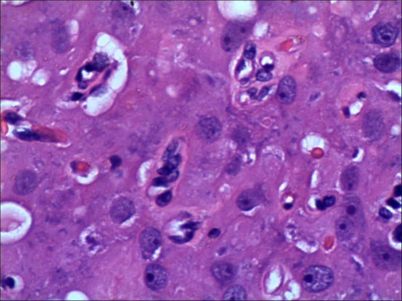 卵巢肿物图5 卵巢肿物图5