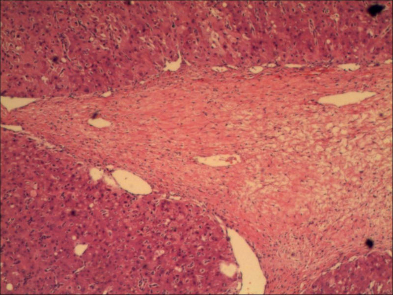 卵巢肿物图17 卵巢肿物图17