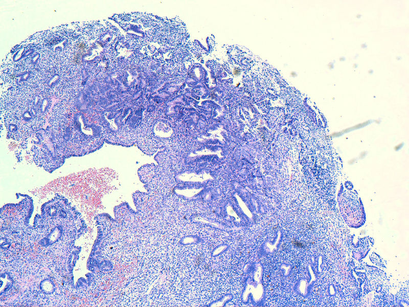 子宫内膜EIN?图2 子宫内膜EIN?图2