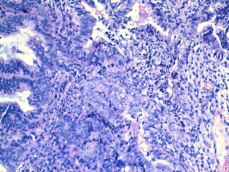 子宫内膜EIN?图4 子宫内膜EIN?图4