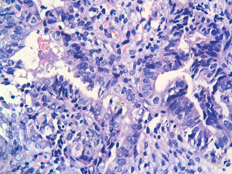 子宫内膜EIN?图6 子宫内膜EIN?图6