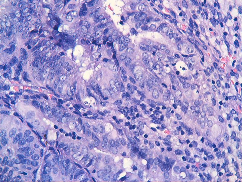 子宫内膜EIN?图12 子宫内膜EIN?图12