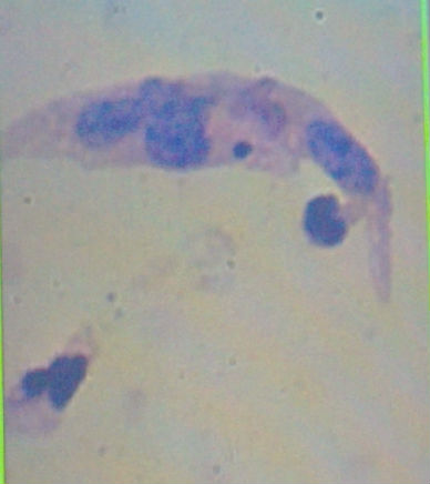 请各位老师帮我看看这个TCT是什么细胞图2