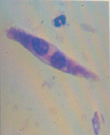 请各位老师帮我看看这个TCT是什么细胞图5