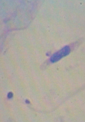 请各位老师帮我看看这个TCT是什么细胞图6