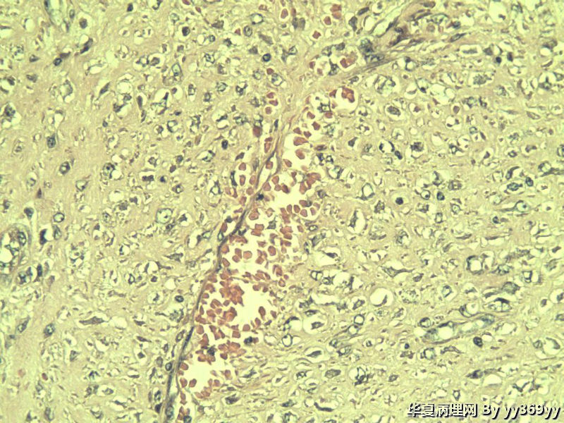 恶性的血管瘤??图1