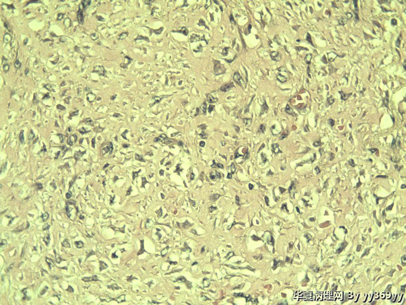 恶性的血管瘤??图2