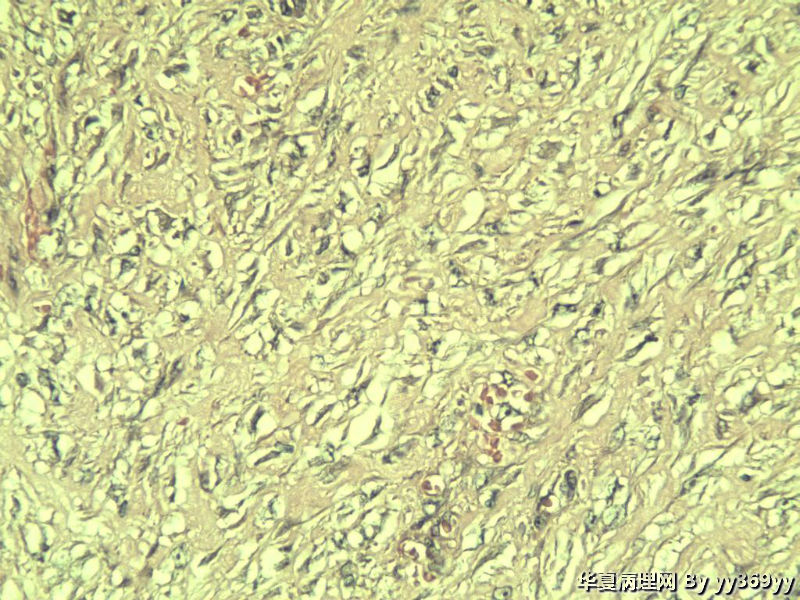 恶性的血管瘤??图3