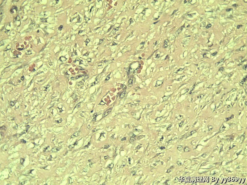 恶性的血管瘤??图4