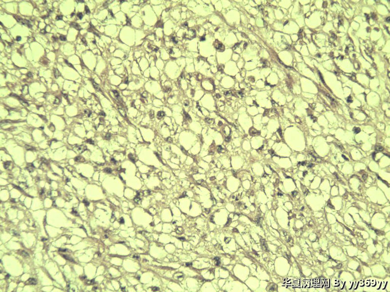 恶性的血管瘤??图6