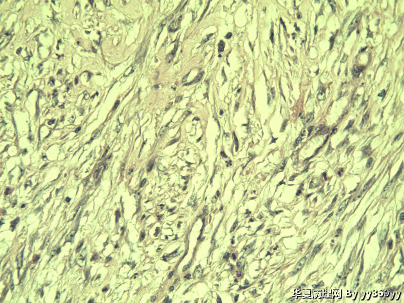 恶性的血管瘤??图7