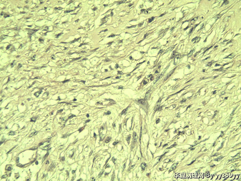 恶性的血管瘤??图8