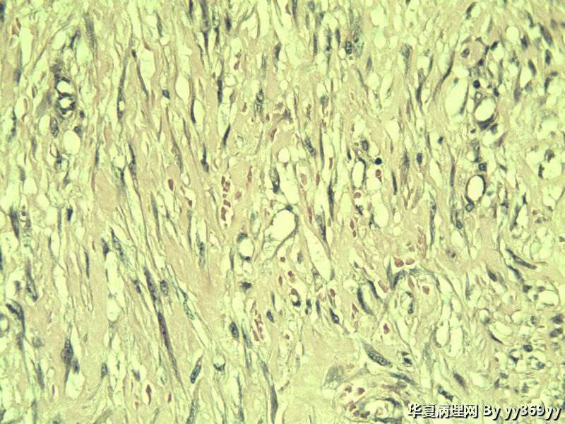 恶性的血管瘤??图9