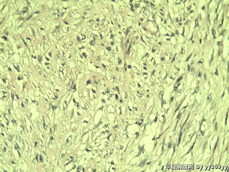 恶性的血管瘤??图10