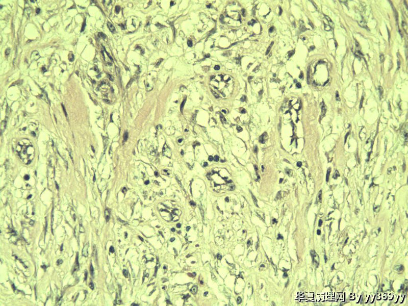 恶性的血管瘤??图11