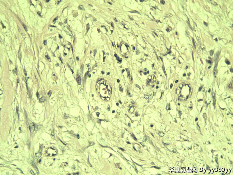 恶性的血管瘤??图12