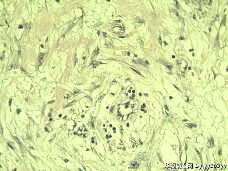 恶性的血管瘤??图13