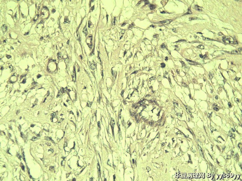 恶性的血管瘤??图14