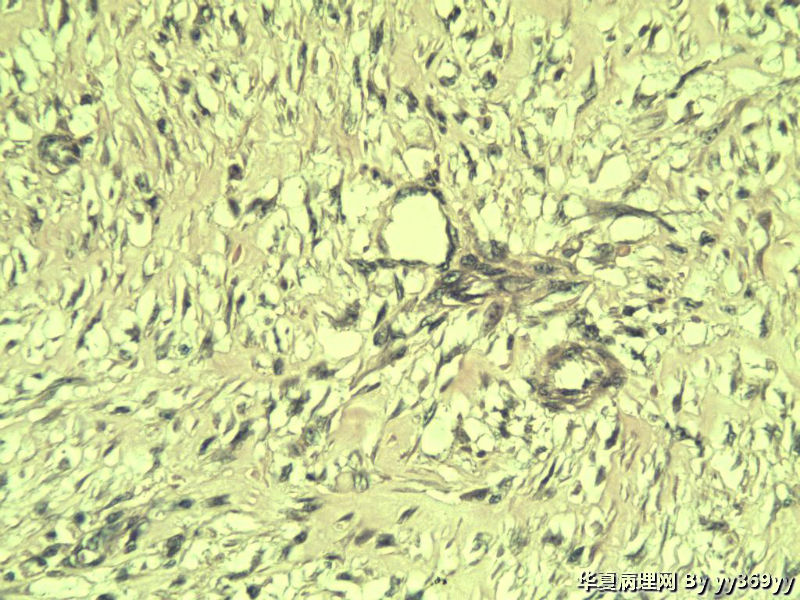 恶性的血管瘤??图15