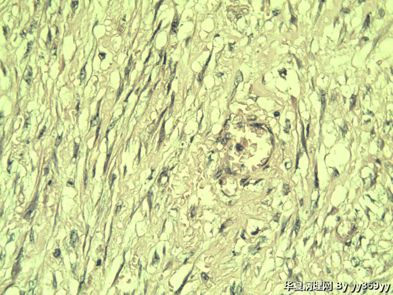 恶性的血管瘤??图16
