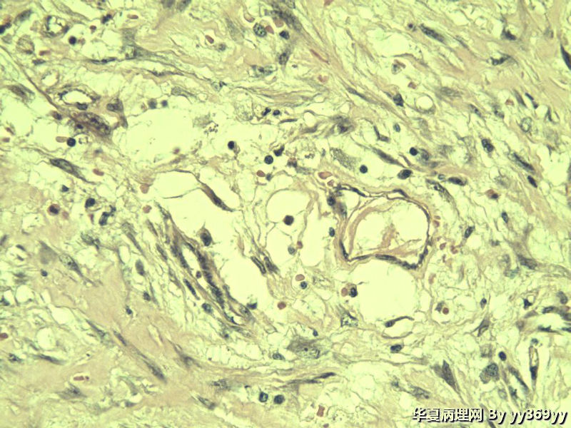 恶性的血管瘤??图17