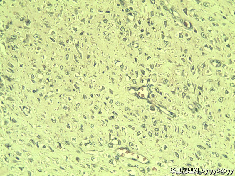 恶性的血管瘤??图18