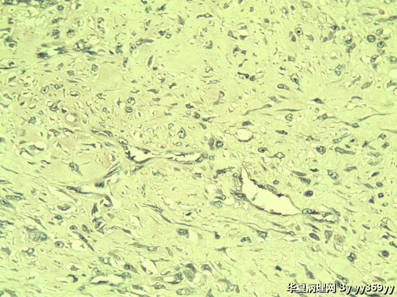 恶性的血管瘤??图20