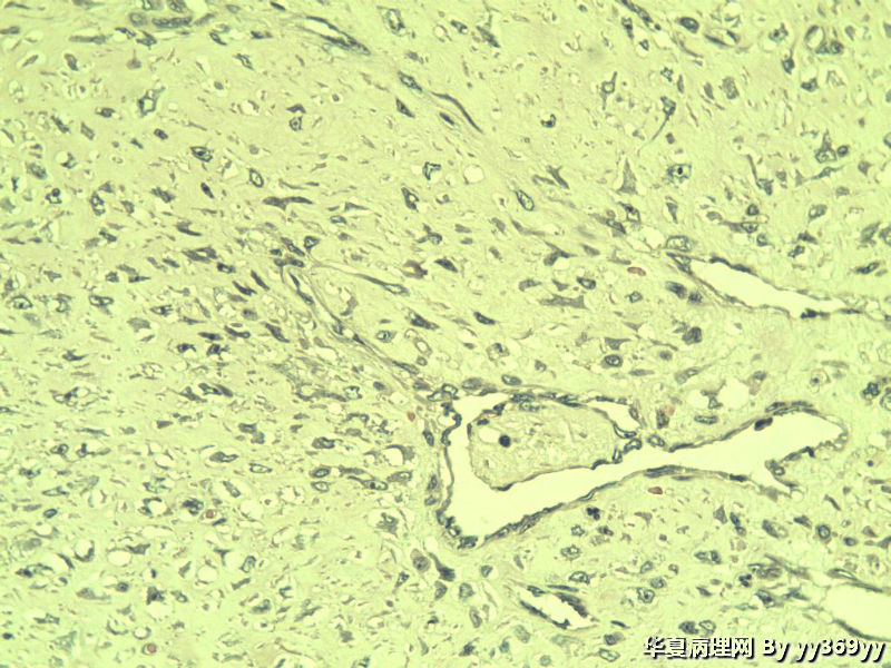 恶性的血管瘤??图21