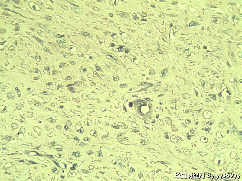 恶性的血管瘤??图22
