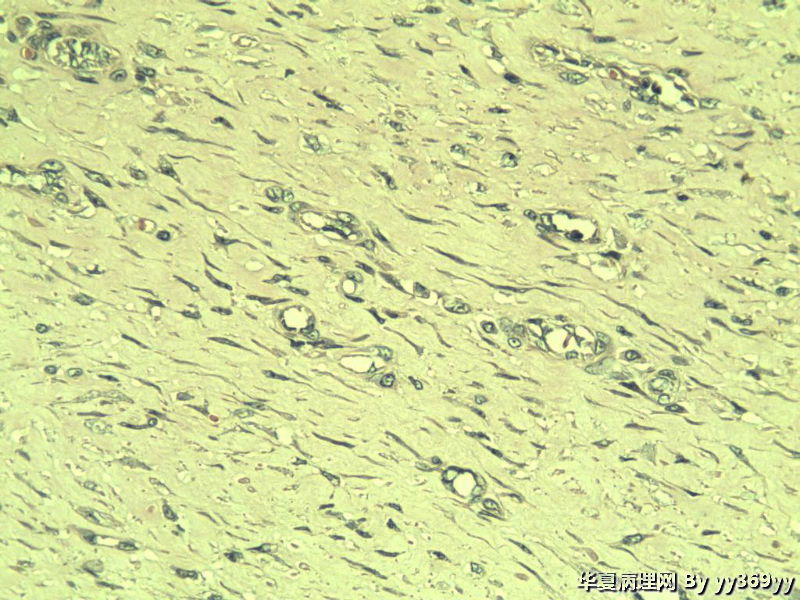 恶性的血管瘤??图23