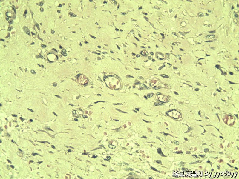 恶性的血管瘤??图24