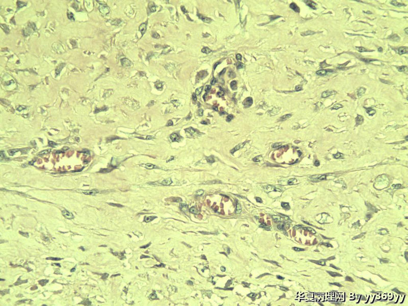 恶性的血管瘤??图25