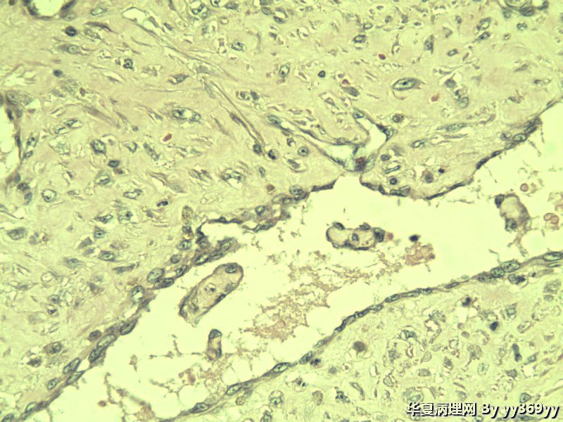 恶性的血管瘤??图26