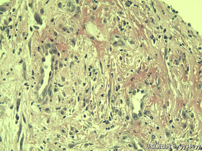 恶性的血管瘤??图27
