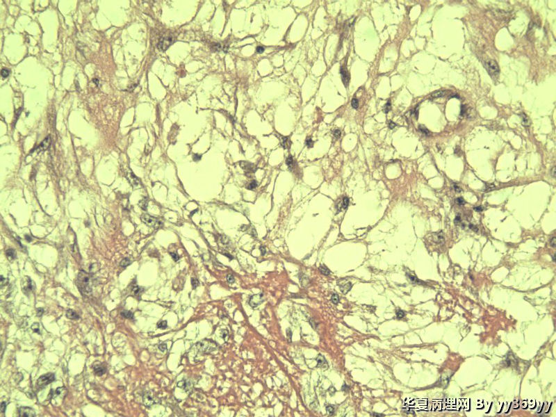 恶性的血管瘤??图28